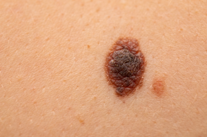 melanoma