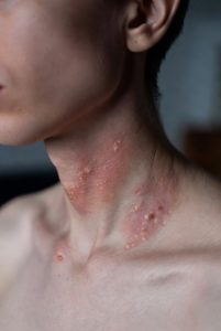Hidradenitis Suppurativa