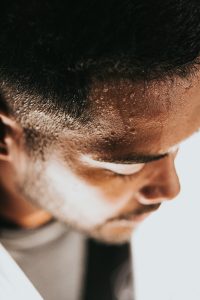 patient with craniofacial hyperhidrosis