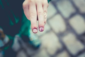 damaged nail