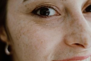 melasma