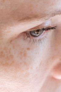 patient with melasma