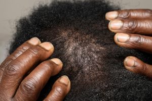 seborrheic dermatitis