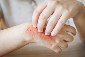 fungal skin infection