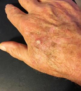 squamous cell carcinoma