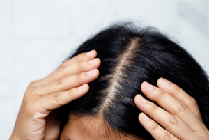 scalp eczema